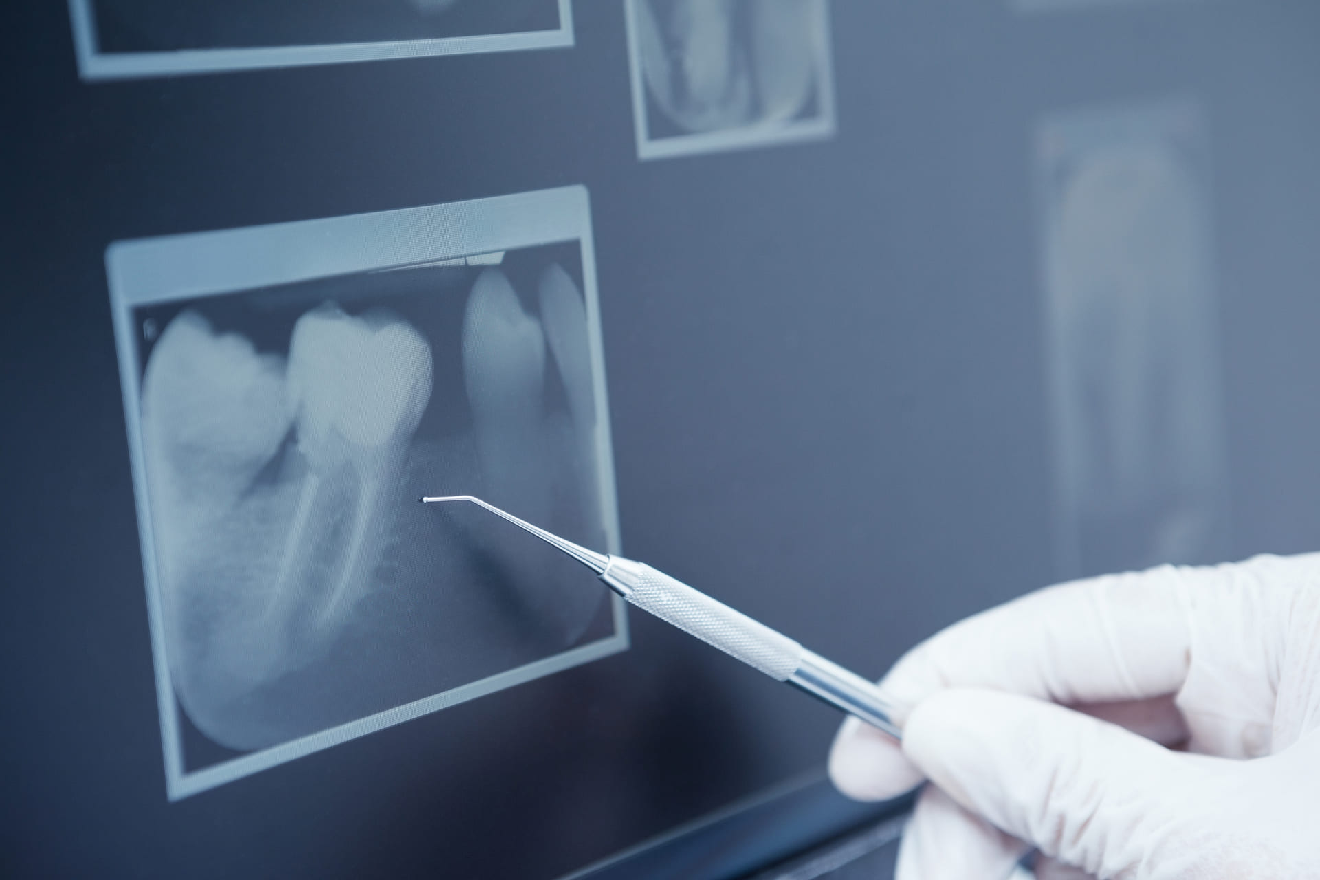 Endodonzia presso il Poliambulatorio Carraro a Busto Arsizio